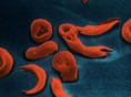/album/hematologia/eritrocitos-enfermos-jpg/